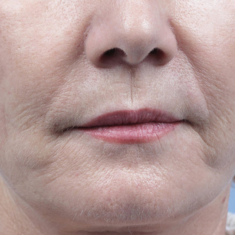 huile de figue de barbarie apraprèsaprès